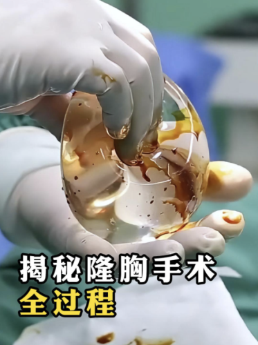 江门中心医院丰胸手术怎么样?手术体验实录