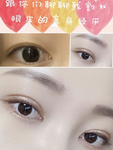 航天七三一医院割双眼皮多少钱?花了12000元,眼睛一下子就变灵动了