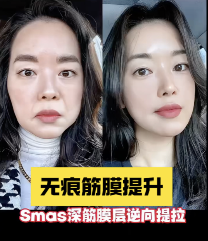 做了面吸多久可以做筋膜提升?3-6个月比较适宜