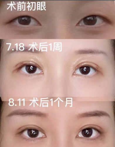 贵州医科大学附属医院割双眼皮多少钱?手术方式不同,价格差别大