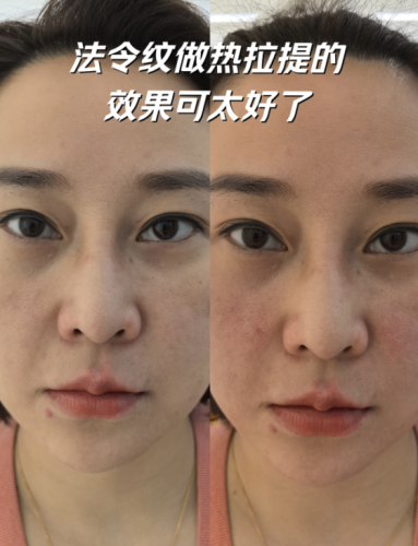 法令纹做什么医美项目比较好?各种去纹大招都有!速来围观!