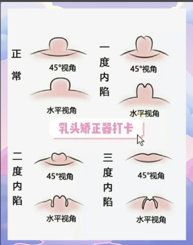 乳头内陷矫正术怎么做?看看哪种方式适合你?