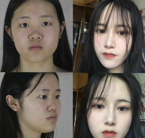 天津医院隆鼻价格,这笔投资值得花在刀刃上