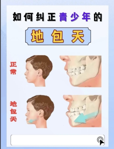 地包天有必要矫正吗?矫正,实为必要之举