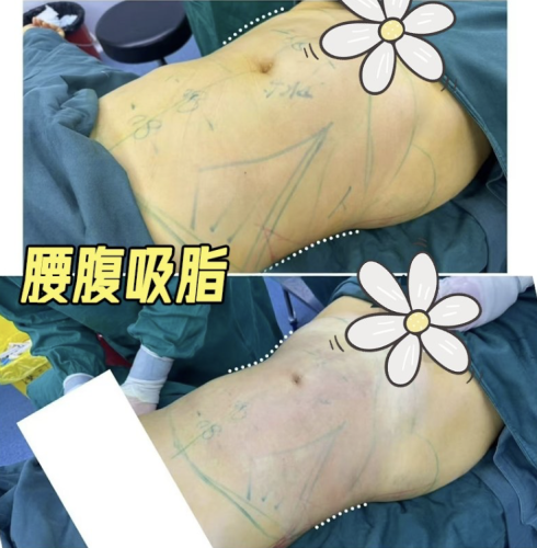 杭州萧山区第一人民医院吸脂多少钱? 来看这份“变美考察清单”