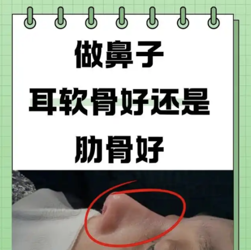 做鼻子用耳软骨还是肋骨做效果好?从不同角度唠一唠