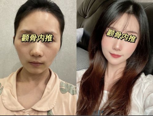 颧骨内推是怎么做的?改变脸型、提升颜值的绝美选择