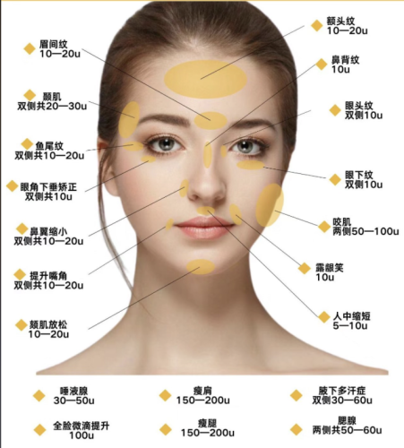 面部除皱针注射部位图:来看看不同部位的注射要点
