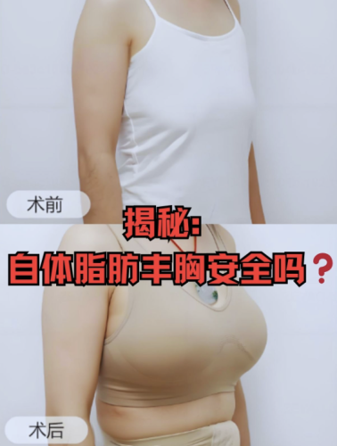 金华中医医院隆胸多少钱?随时面诊,不会有乱收费的情况