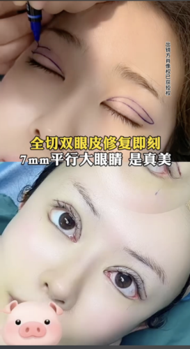 武汉中心医院割双眼皮多少钱?这得从多个方面来分析