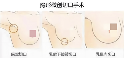 广西人民医院丰胸手术怎么样?成就完美胸型的“秘密武器”