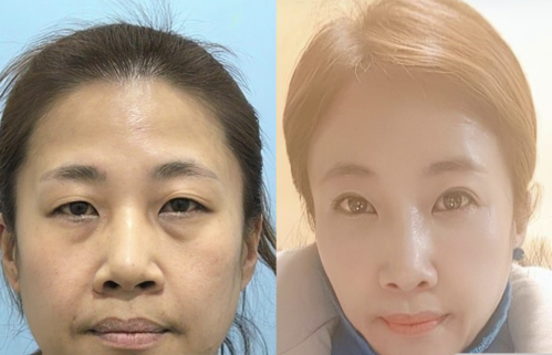 成都金牛区人民医院拉皮除皱多少钱?一站式实现颜值逆袭