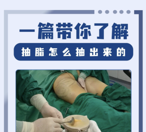 淄博第一医院抽脂好吗?专业的医生团队+合理的价格