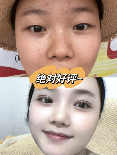 北京空军特色医学中心割双眼皮多少钱?给宝子们整了份“懒人价目表”