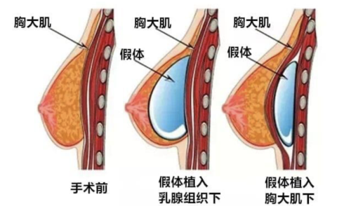 合肥第一人民医院丰胸手术怎么样？专业医生团队，技术精湛有保障