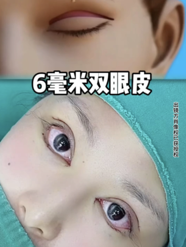 龙岩第二医院割双眼皮多少钱?收费3000-8000元,想一劳永逸的宝子冲这个!