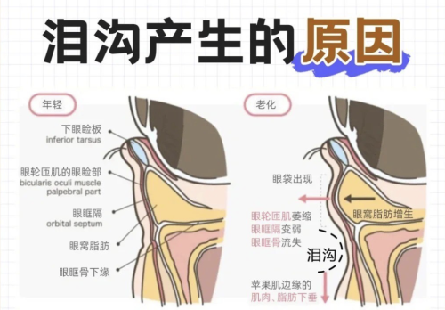 泪沟的形成原因及解决方法? 医美治疗是快速有效的选择