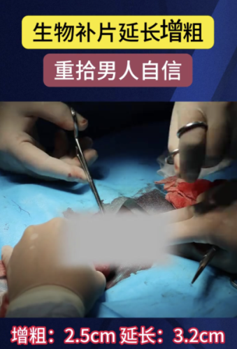 生物补片增粗成功案例:实现阴茎增粗的效果