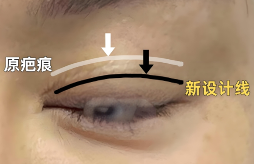 双眼皮修复是不是重新做一次?需要注意什么