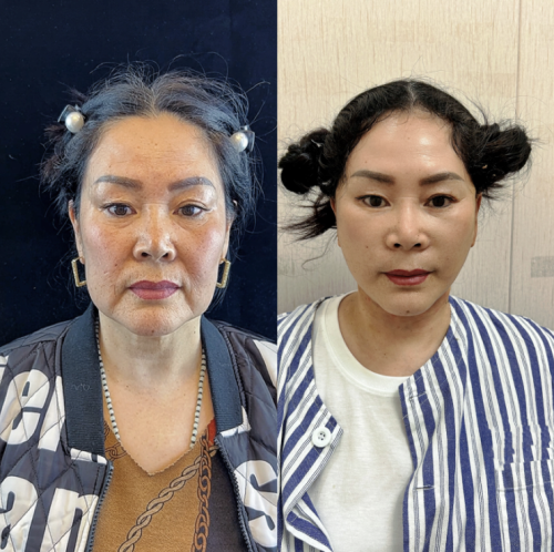 烟台莱阳中心医院拉皮除皱多少钱？价格大致如下