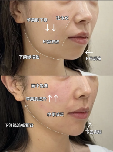 内轮廓固定提升能保持多久时间？实现美丽直接“超长待机”！