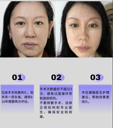 上海新华医院拉皮除皱多少钱?不同术式价格能差出一辆代步车!