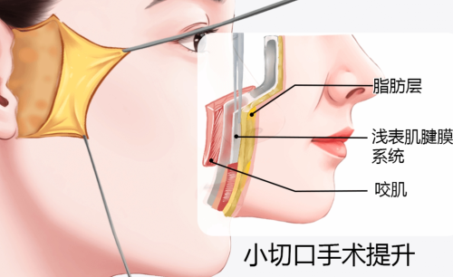 拉皮手术能维持几年?所有人都能做吗