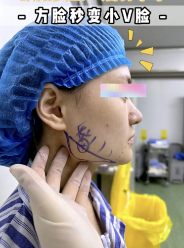 磨下颌角和切下颌角的区别：操作手法大不同