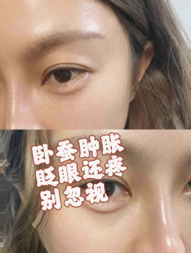 卧蚕填充后肿几天消肿？不同填充方式的消肿节奏有啥区别？