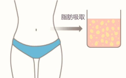 腰腹环吸抽脂需要穿多久塑身衣？术后恢复关键期，别小看这一步