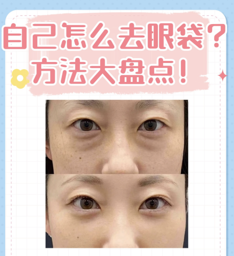 宁波第二医院去眼袋挂什么科?别着急,今天咱就把这事儿唠个明明白白!