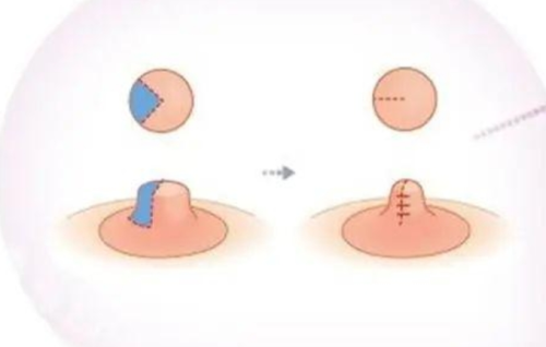 乳头缩小手术多少钱？别只看价格，术前术后这些也要知道