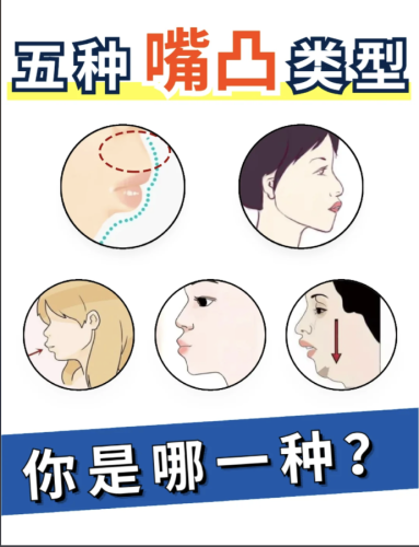 矫正嘴凸多久可以看到效果？找对方法，实现牙齿快速“归位”