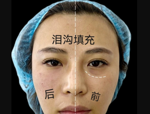 胶原蛋白填充泪沟能维持多久？真实数据告诉你答案