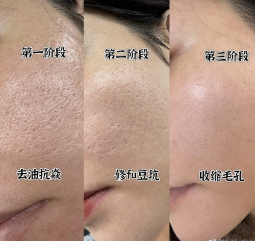 做黄金微针后爆痘正常吗？真相揭开，让你心里有底！