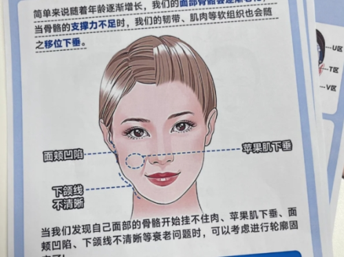 内轮廓固定用什么材料？一文看懂选料逻辑和避坑指南