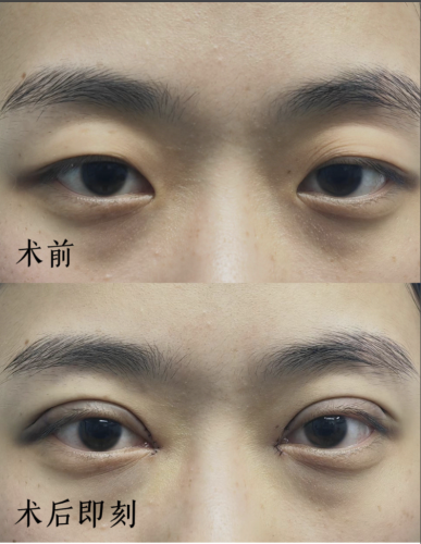 李昆瑾医生双眼皮案例:40 分钟见证美丽蝶变
