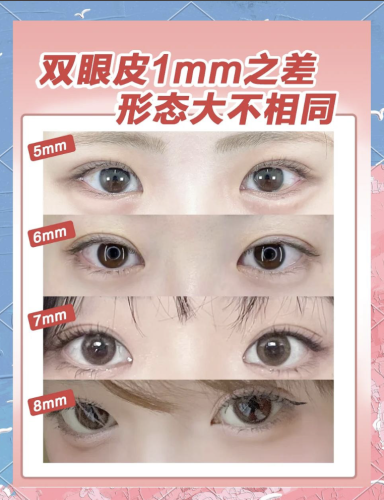 哈尔滨瑞丽双眼皮多少钱?不同价格的双眼皮效果如何?