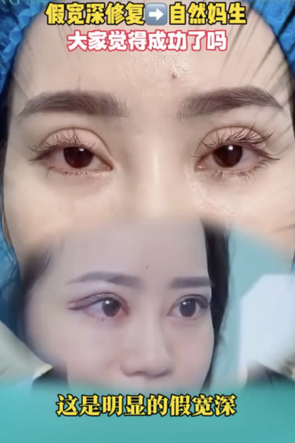 哈尔滨瑞丽整形双眼皮修复怎么样?真能把 “失败眼” 变 “电眼”?3 个案例说真相