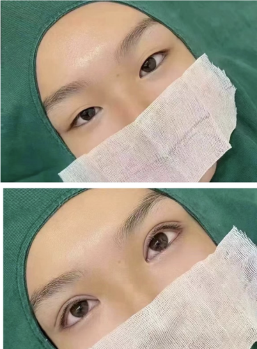 哈尔滨艺星做双眼皮怎么样?花样百出,总有一款适合你