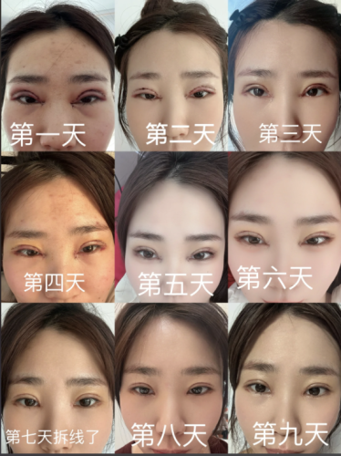 哈尔滨瑞丽谁做双眼皮修复好?3 位医生 PK 表帮你选