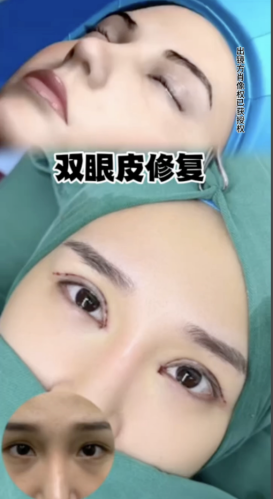 哈尔滨瑞丽双眼皮修复哪位主任做得好?3 组真实案例 + 手术细节大起底