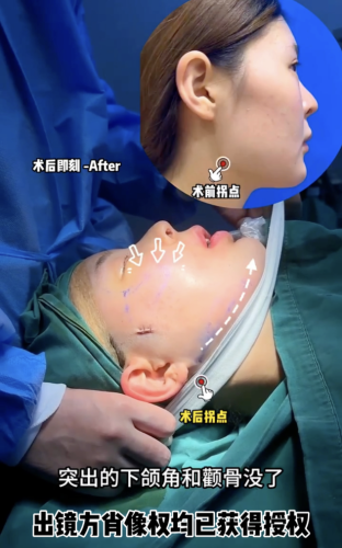 颧骨高磨骨手术需要多少钱?8w 换头术的人间真实