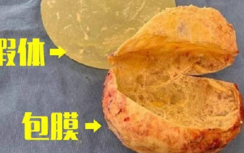 包膜挛缩是怎么引起的？当假体被困“紧身衣”，是怎么被一步步逼出来的？