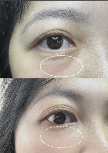 哈尔滨瑞丽哪个做泪沟做得好？40岁的李女士是这样选的