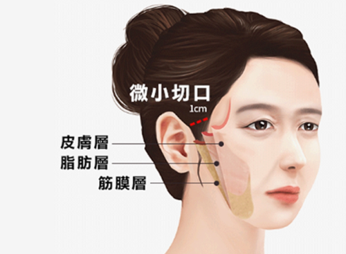 做筋膜提升后的后遗症，一篇干货教你避开“脸崩”雷区