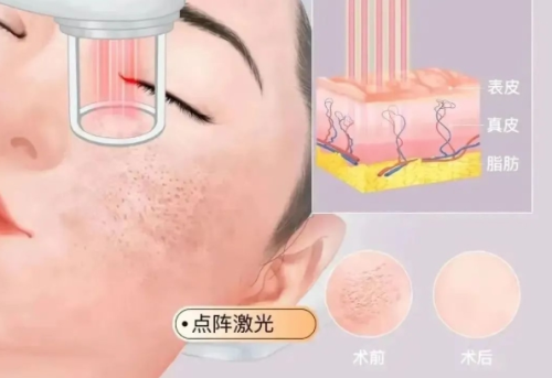 点阵激光对陈旧性疤痕有用吗？十年老疤还有救吗？