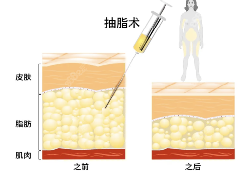 哈尔滨脂肪吸脂多少钱？要看吸脂量在1000cc以下还是3000cc以上