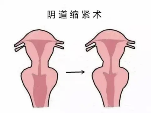 阴道紧缩针的副作用和危害：从尴尬到致命的5重打击