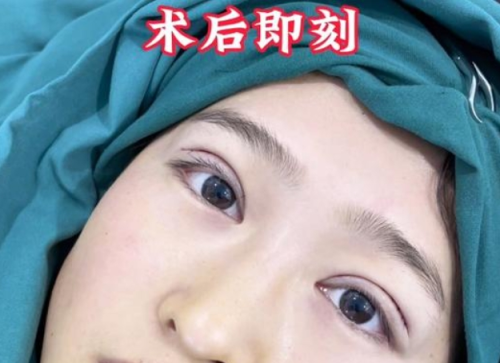 汪腊一医生割双眼皮怎么样?想割又不敢割?汪腊一来种草!